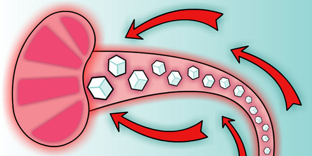 آسیب کلیوی در دیابت